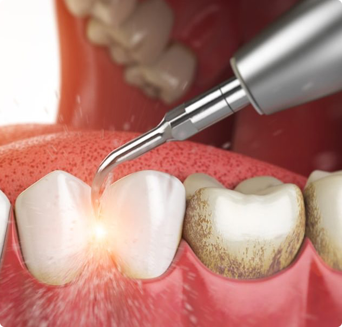 Удаление зубного камня быстро и безболезненно