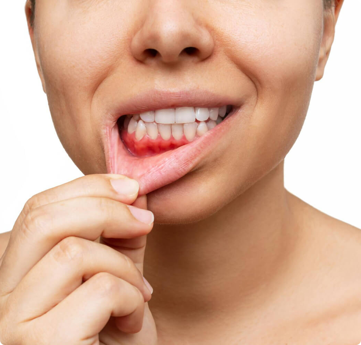 Лечение пародонтоза