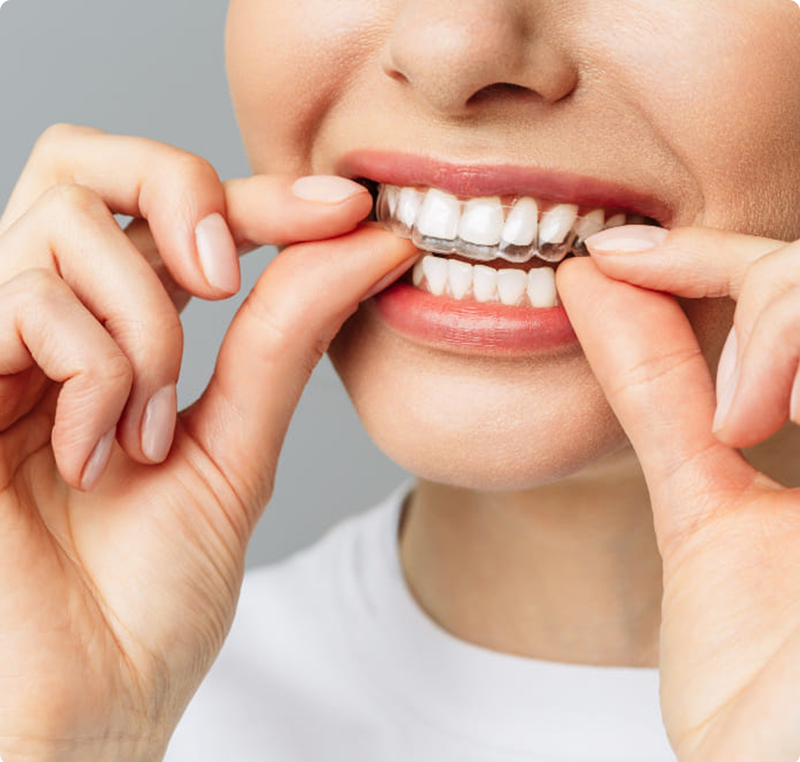 Элайнеры для выравнивания зубов