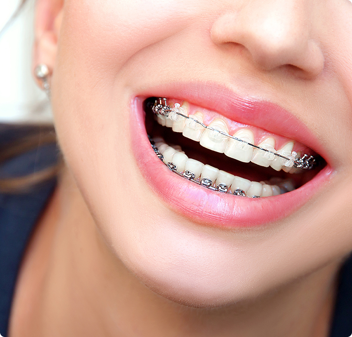 Керамические брекеты по выгодной цене