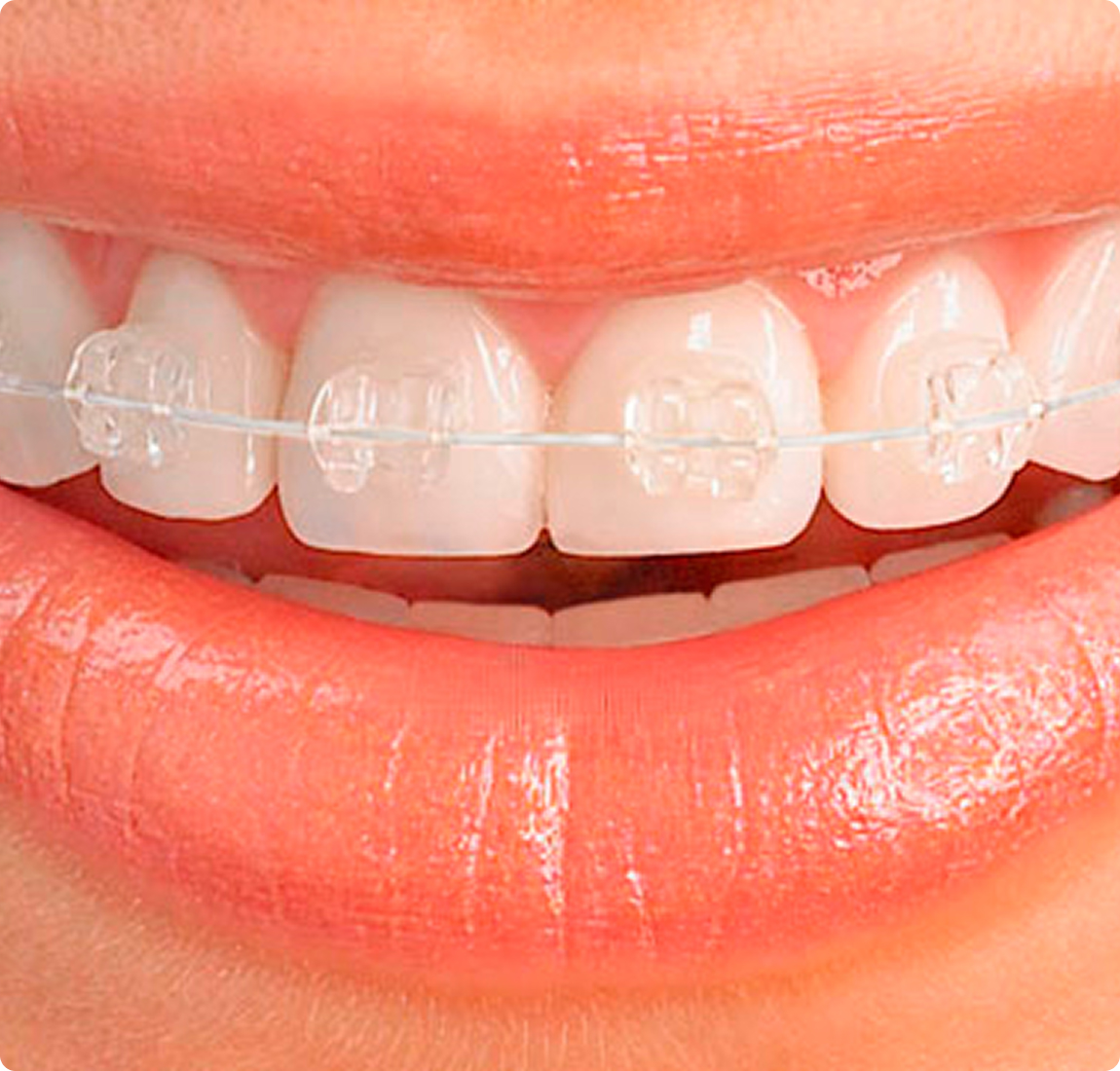 Невидимые брекеты