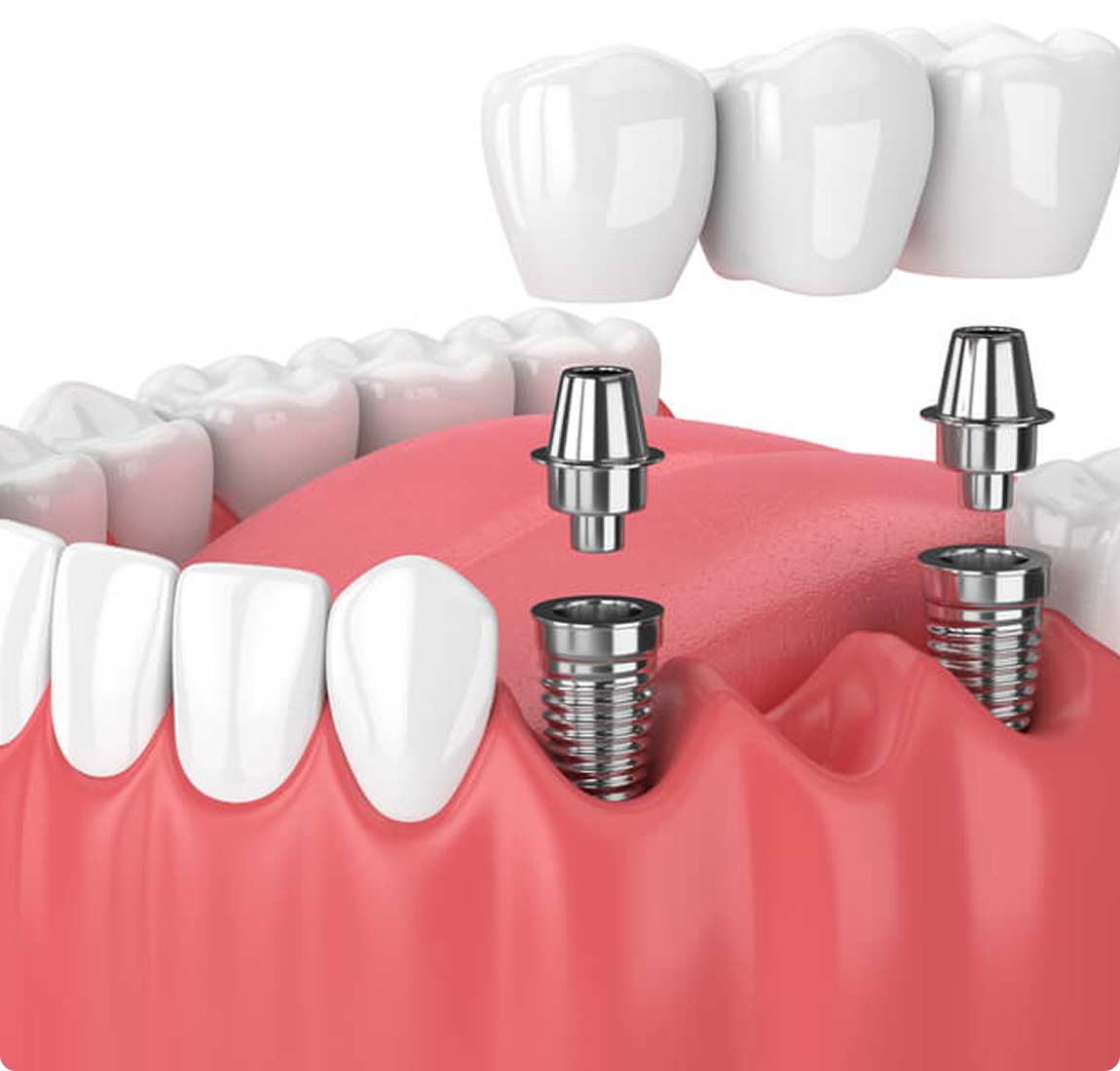 Несъёмные зубные протезы