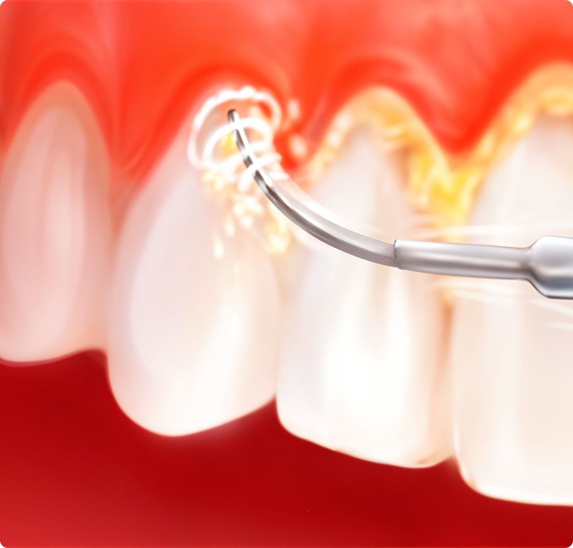 Ультразвуковая чистка зубов