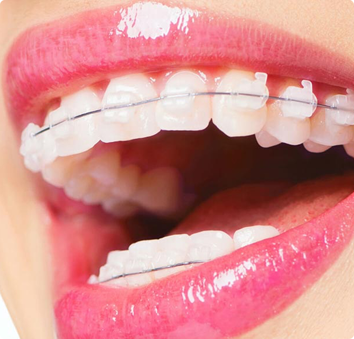 Сапфировые брекеты