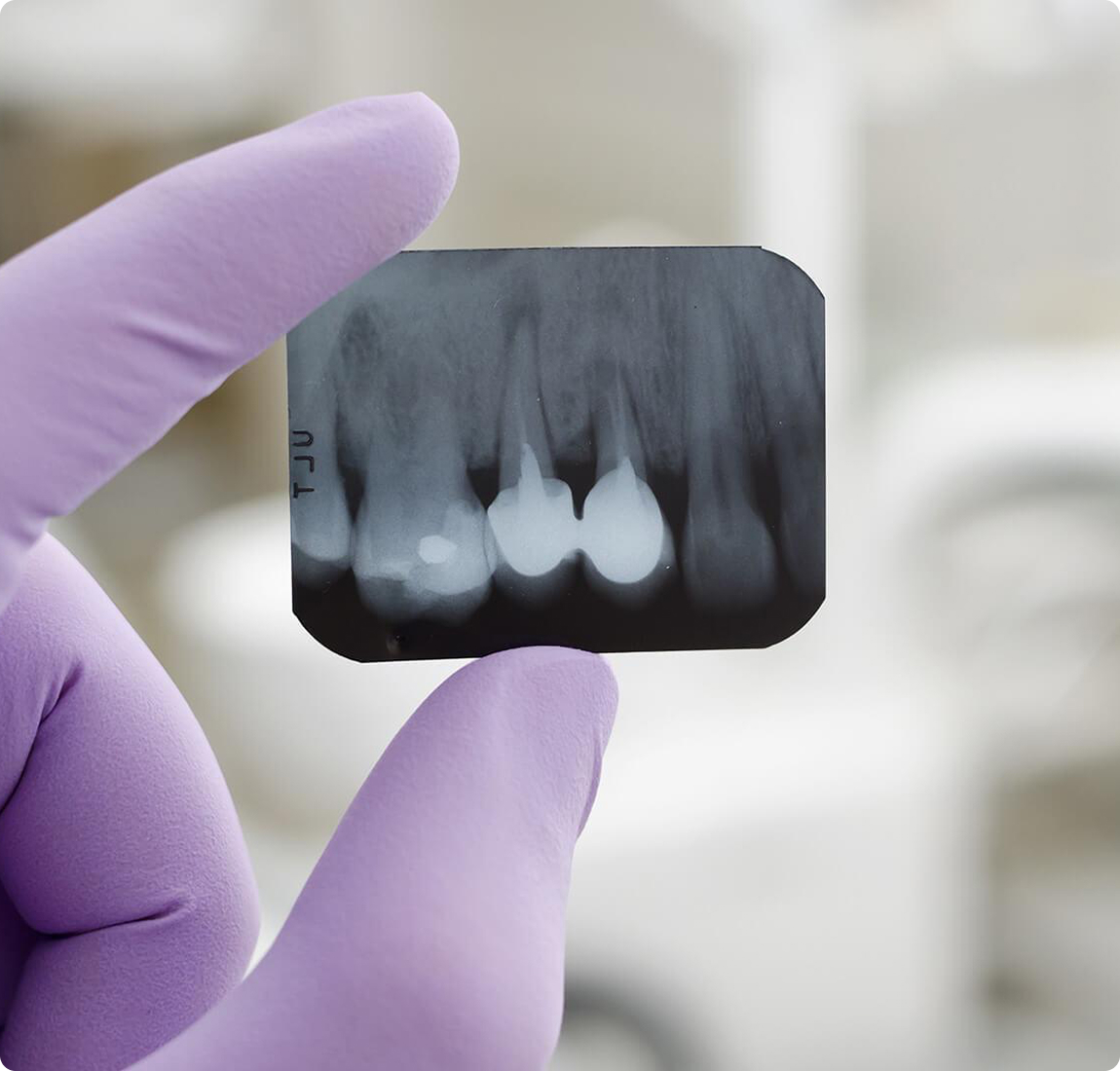 Прицельный снимок зубов