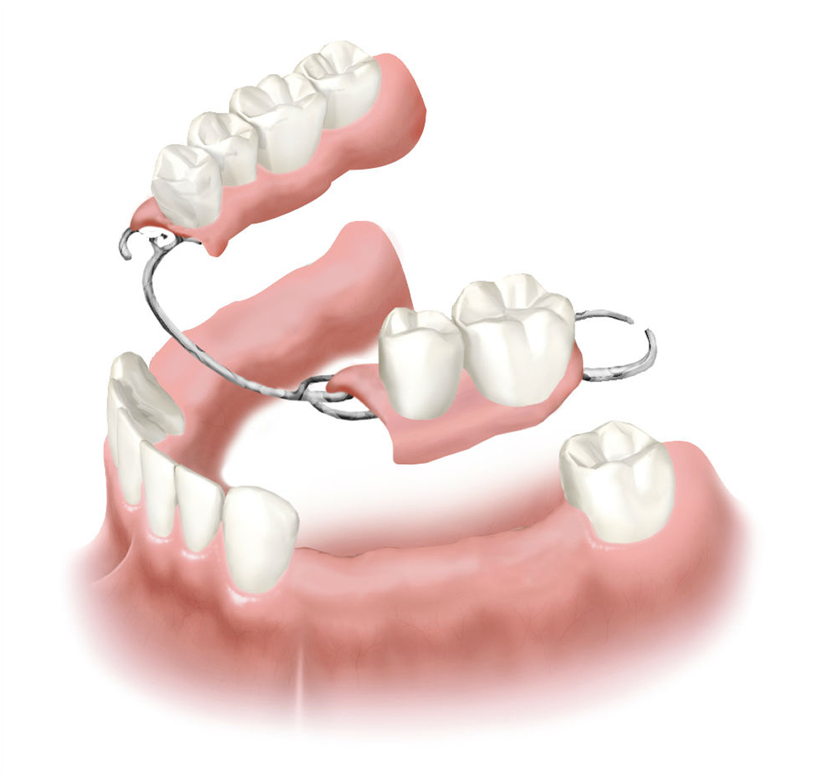 Бюгельные протезы